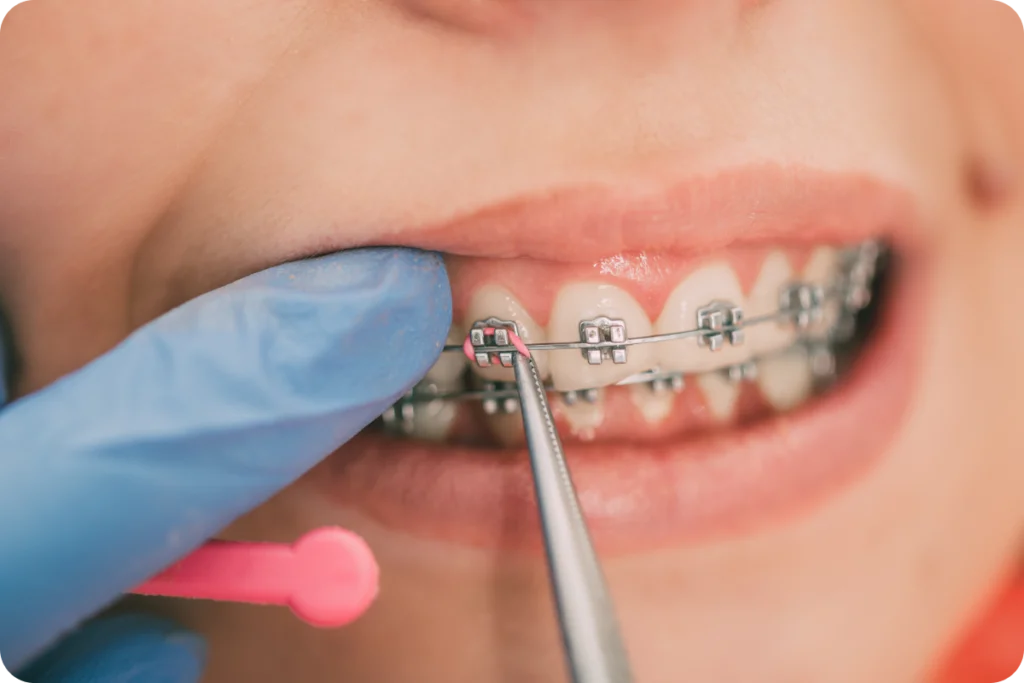 Les incidents en orthodontie